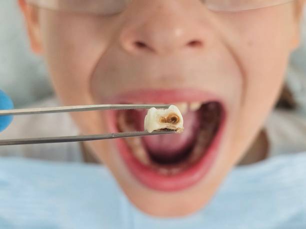 Best Urgent Tooth Repair  in Cleveland, AL
